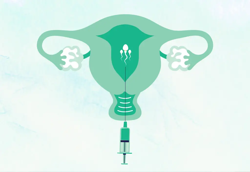ขั้นตอนการทำ IUI หรือการฉีดเชื้อเข้าโพรงมดลูกเพื่อแก้ปัญหามีบุตรยากที่ GFC Clinic