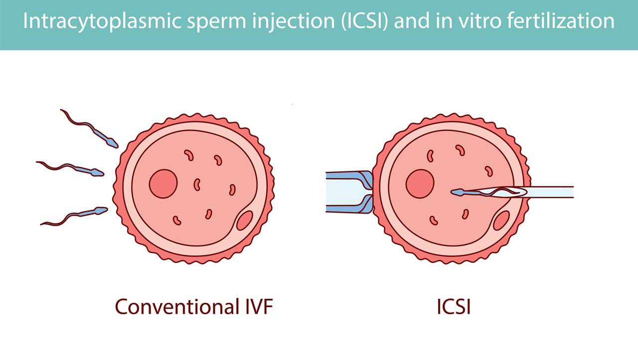 ICSI