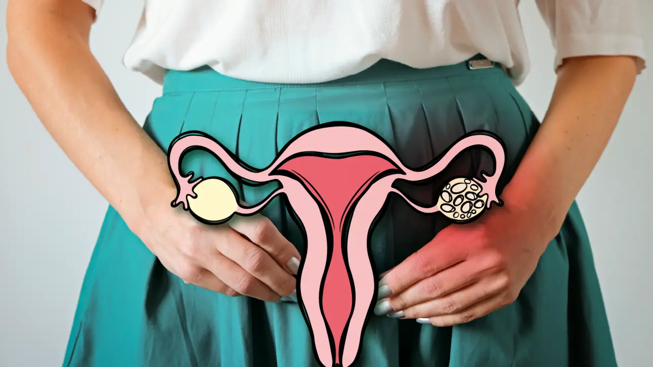 ภาวะถุงน้ำในรังไข่หลายใบ (PCOS) สาเหตุของการมีบุตรยากและแนวทางการรักษาที่ GFC Clinic